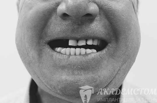 Пациент средних лет нуждается в протезировании зубов