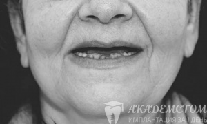 У женщины диагностирована адентия и разрушение фронтальных зубов