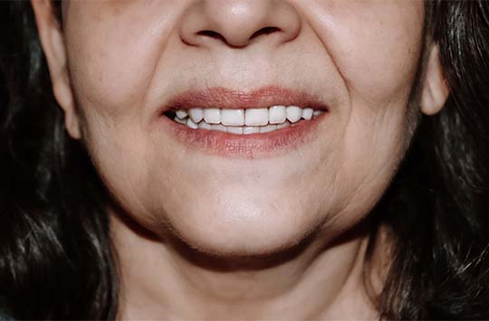 Пациентке установлены идеально ровные и белоснежные зубные протезы