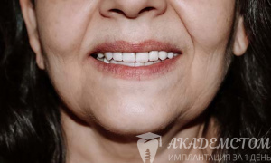 Пациентке установлены идеально ровные и белоснежные зубные протезы
