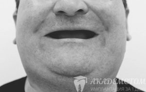 Состояние зубов пациента до лечения - полная адентия обеих челюстей
