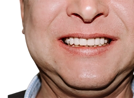 Фото верхней челюсти после восстановления зубов системой Zygoma