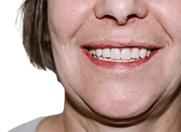 Полное восстановление зубов обеих челюстей методиками All-on-4 и All-on-5