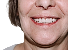 Полное восстановление зубов обеих челюстей методиками All-on-4 и All-on-5