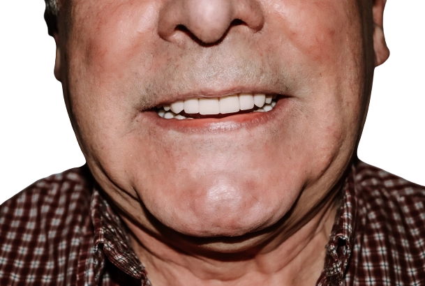Снимок челюсти пациента с новыми протезами
