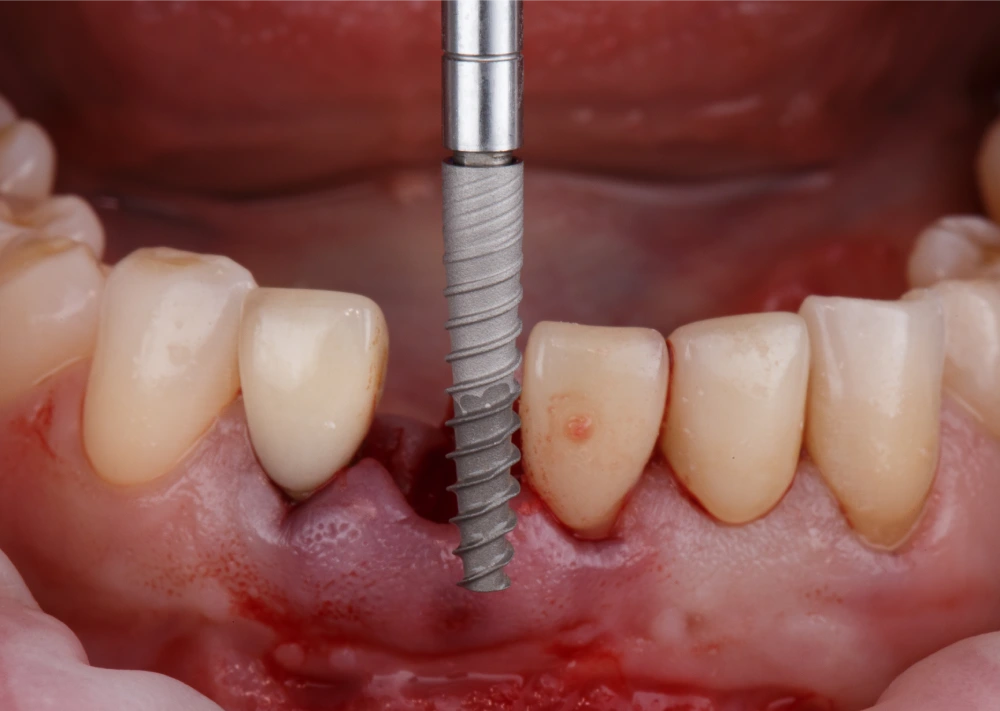 Имплант установлен в базальный слой челюстной кости