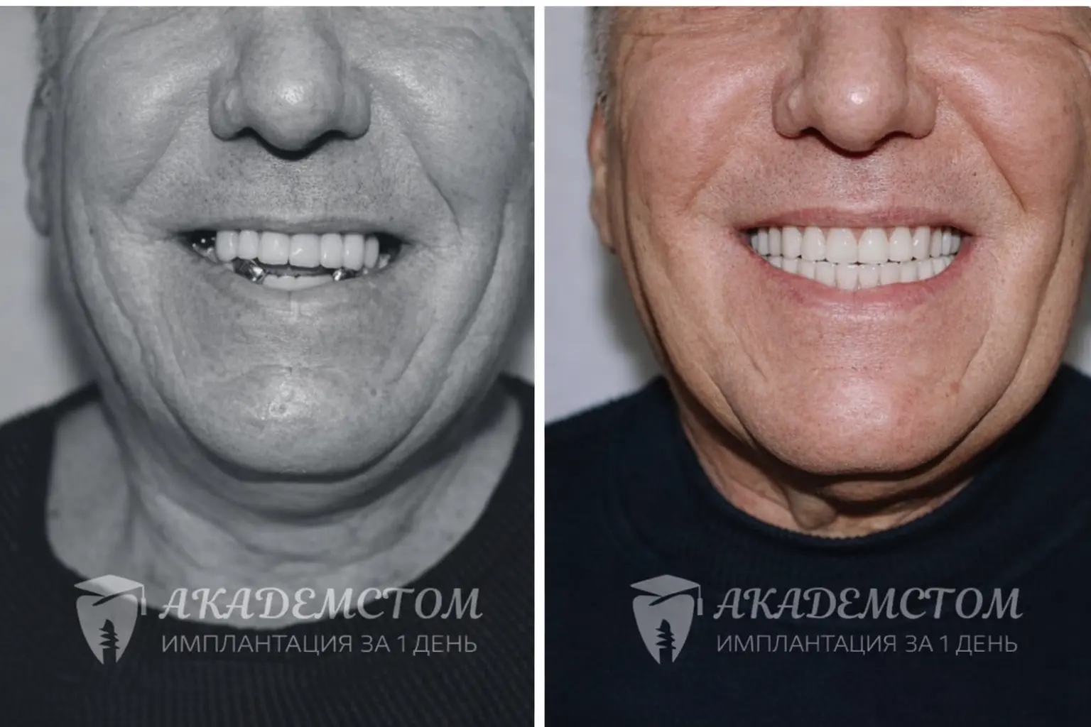 Не просто новые зубы в 67 лет, а новая жизнь! 