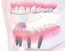 Имплантация зубов All-on-4 со скидкой – 110 000 рублей