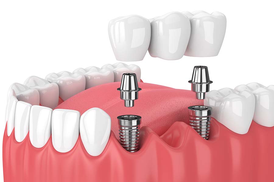 Зубной мост на имплантах