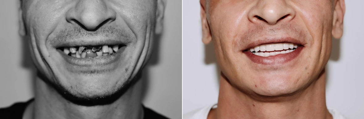 Новые зубы за 3 дня при диабете