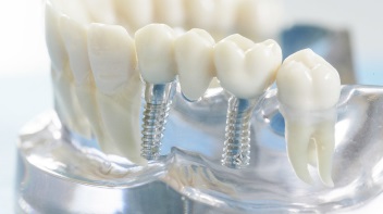 Нет жевательных зубов — что делать, какой протез поставить