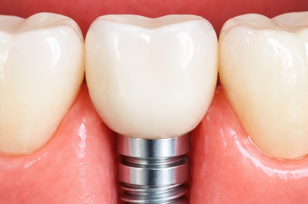 Здоровье десны продлевает срок службы импланта