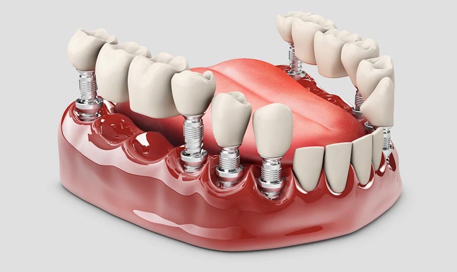 Какую имплантацию зубов выбрать: сразу после удаления или классическую