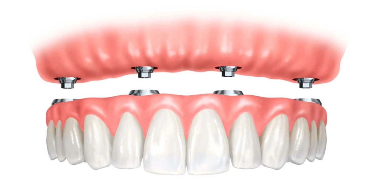 Особенности имплантации верхних зубов