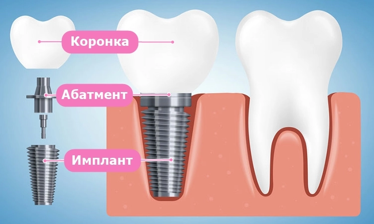 протезирование коронками