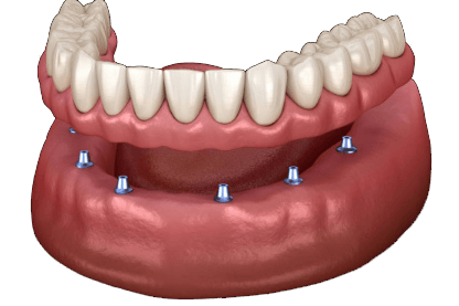 Применение имплантации по методу All-on-6 на примере 2D модели нижней челюсти
