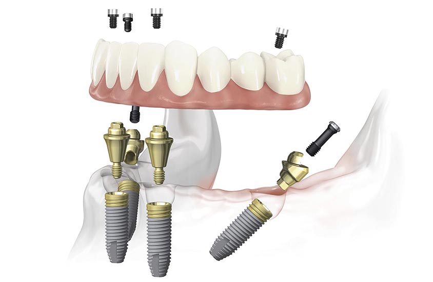 Израильские импланты AB Dental