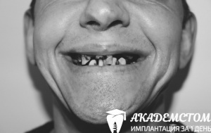 Пациент обратился в клинику Академстом с частичным разрушением, адентией верхних и нижних зубов.