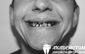 Пациент обратился в клинику Академстом с частичным разрушением, адентией верхних и нижних зубов.