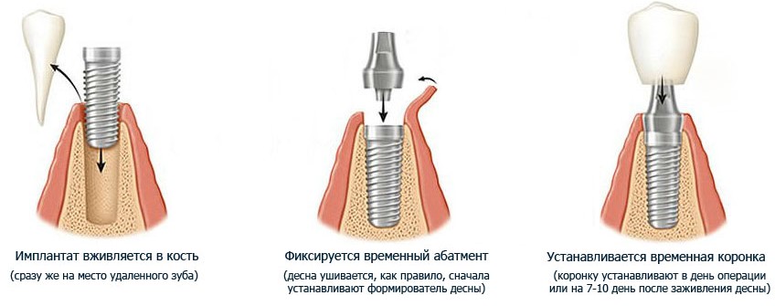 Одноэтапная имплантация зуба