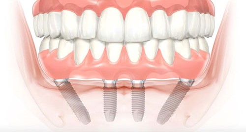 Имплантация зубов all-on-4