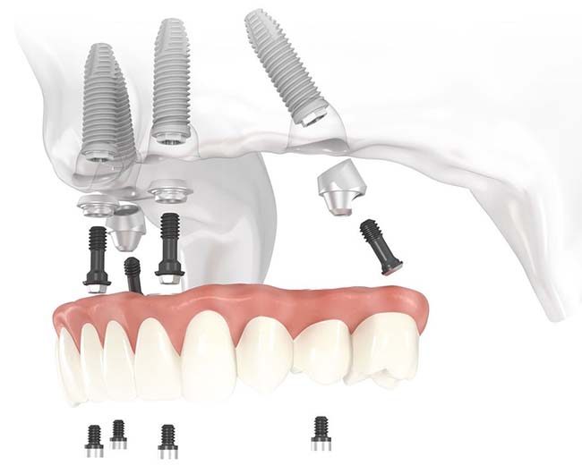 Иимплантация и протезирование верхней челюсти без зубов