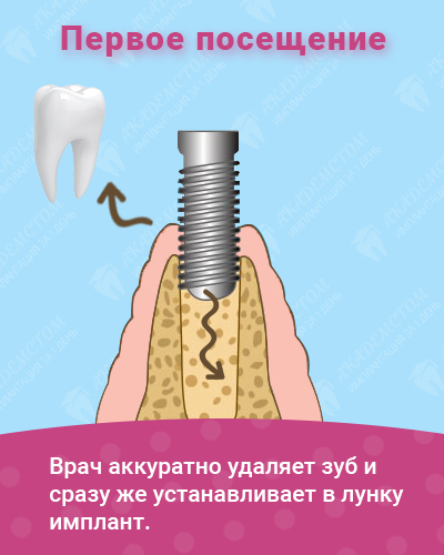 Врач аккуратно удаляет зуб и сразу же устанавливает в лунгу имплант