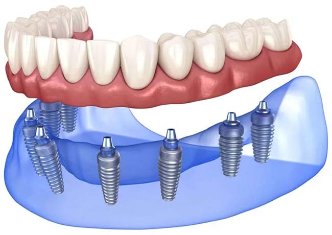 Метод классической имплантации зубов всей челюсти